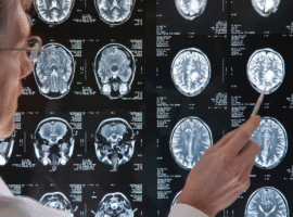 Understanding Tumor Grades (I through IV)