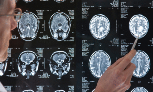 Understanding Tumor Grades (I through IV)