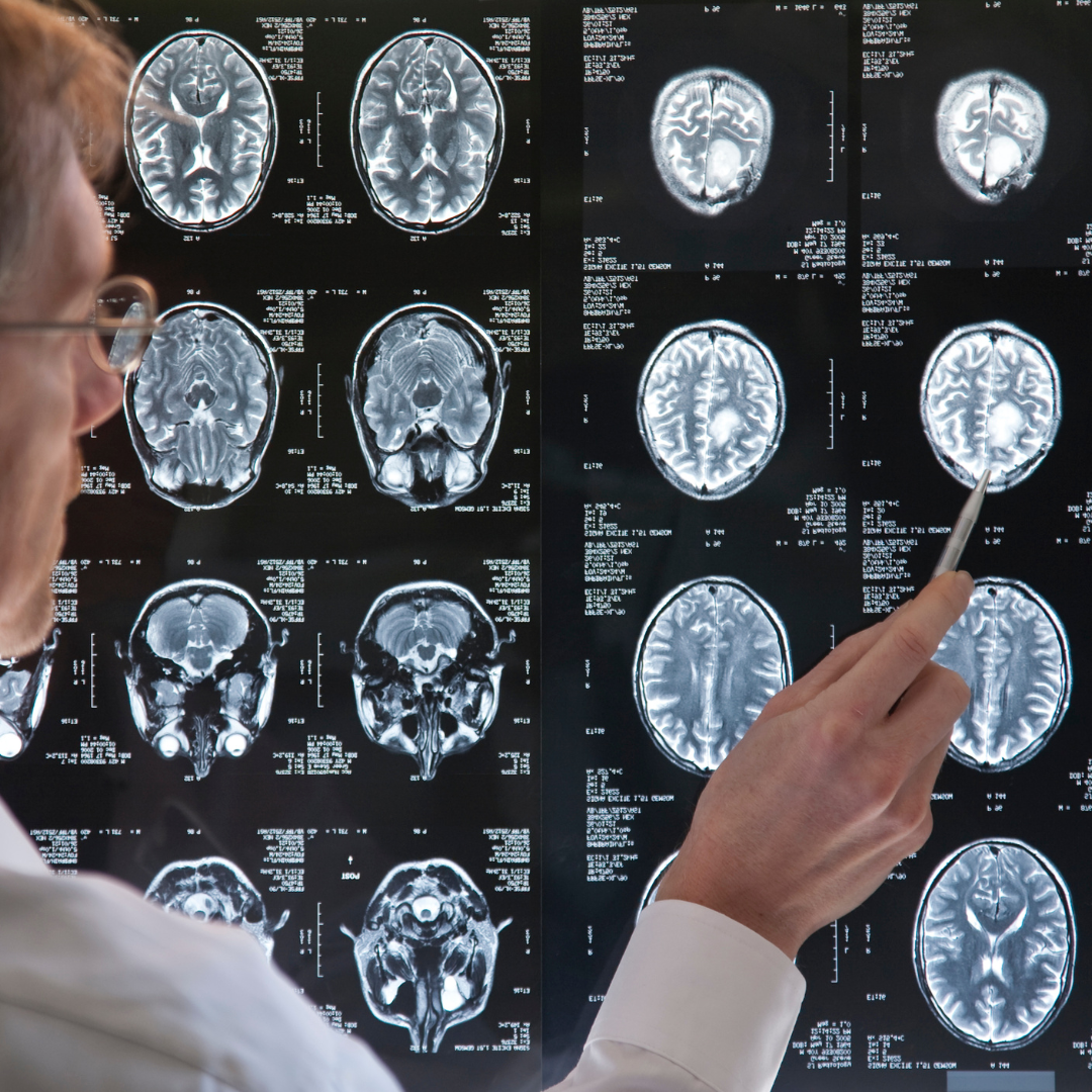Understanding Tumor Grades (I through IV)